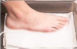 Adjusting Hidroxa iontophoresis machine settings for hyperhidrosis treatment